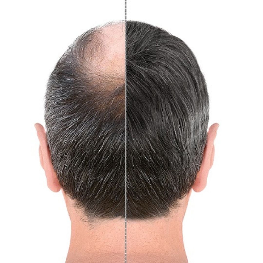 Hair Transplant Varchas Wellness Bangalore